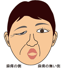 図2　顔は動くが、口を尖らすと目も閉じてしまうなど、異常（病的）な運動が起きる