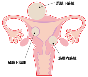 子宮の図（子宮筋腫）