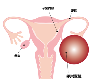 子宮の図（卵巣嚢腫）