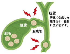 胆石によって生じる「痛み」