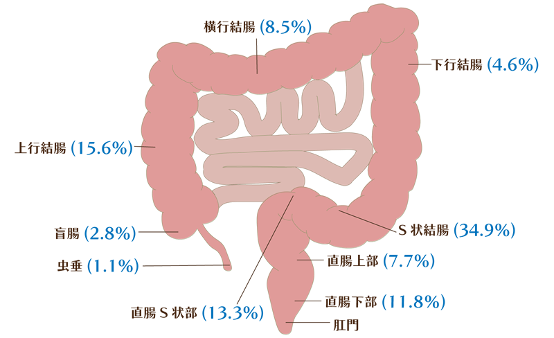 図：大腸がんの部位別発生頻度